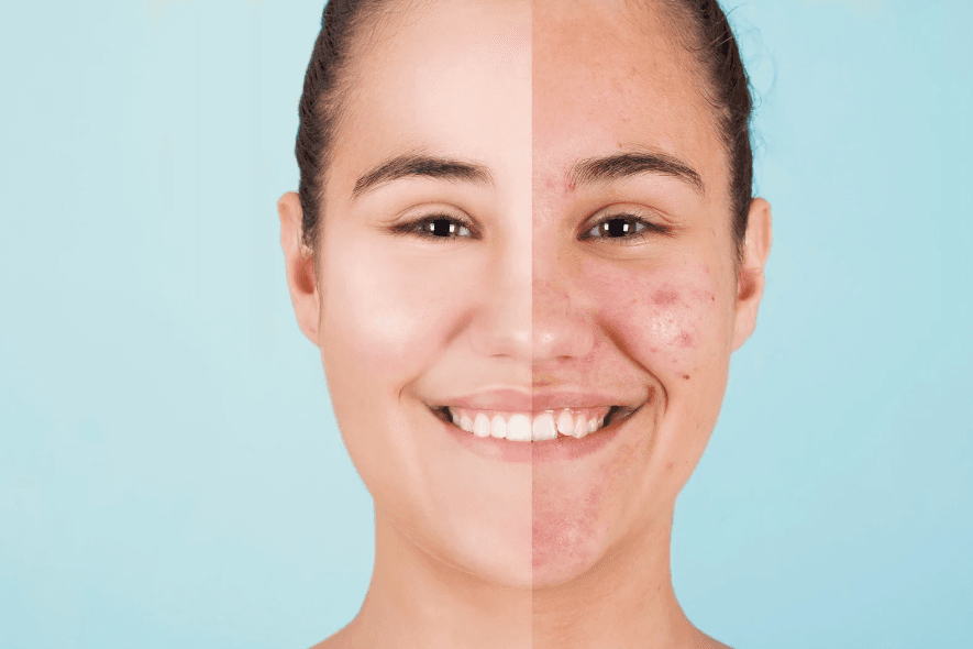 Acne Facial