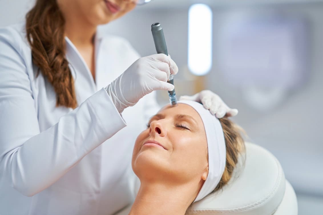 Microneedling and RF microneedling on Vivace and Potenza