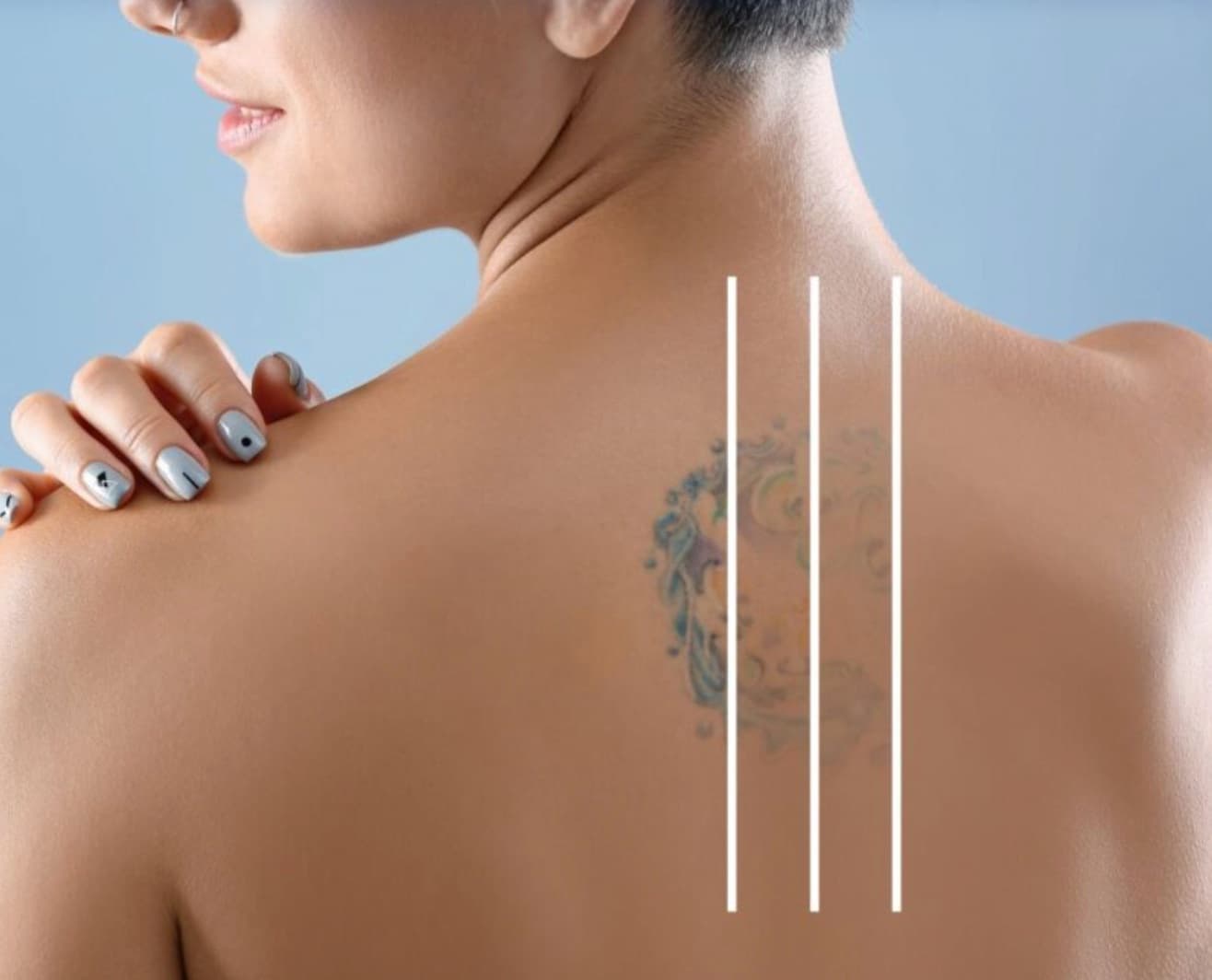Laser Tattoo Removal